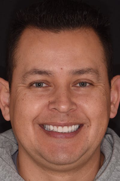 Patient Smile Before & After Gallery - Patient 164636 - Image 2