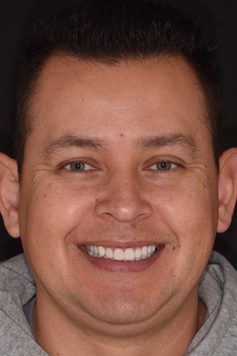 Patient Smile Before & After Gallery - Patient 164636 - Image 2