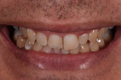 Patient Smile Before & After Gallery - Patient 138386 - Image 1