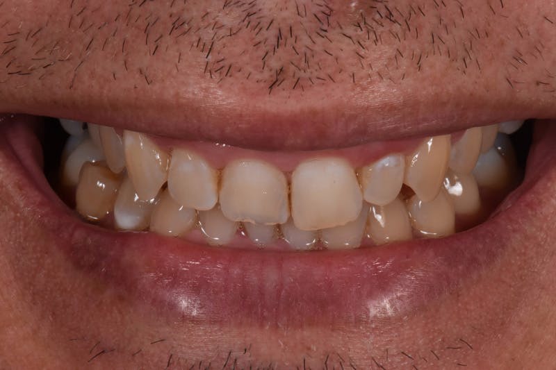 Patient Smile Before & After Gallery - Patient 138386 - Image 1