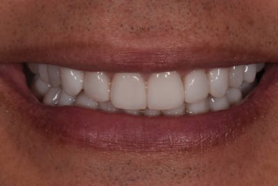 Patient Smile Before & After Gallery - Patient 138386 - Image 2