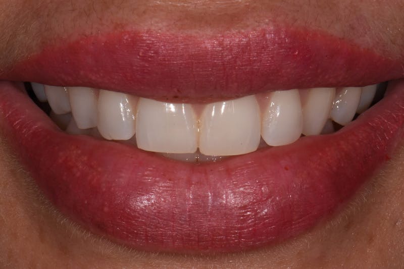Patient Smile Before & After Gallery - Patient 175633 - Image 3