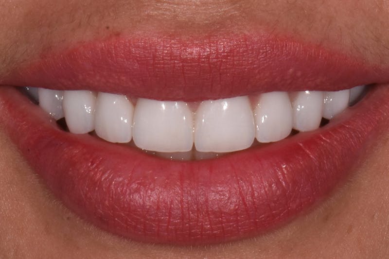 Patient Smile Before & After Gallery - Patient 175633 - Image 4