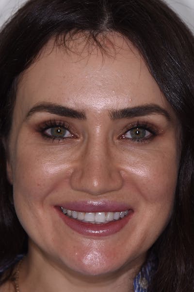 Patient Smile Before & After Gallery - Patient 183482 - Image 1