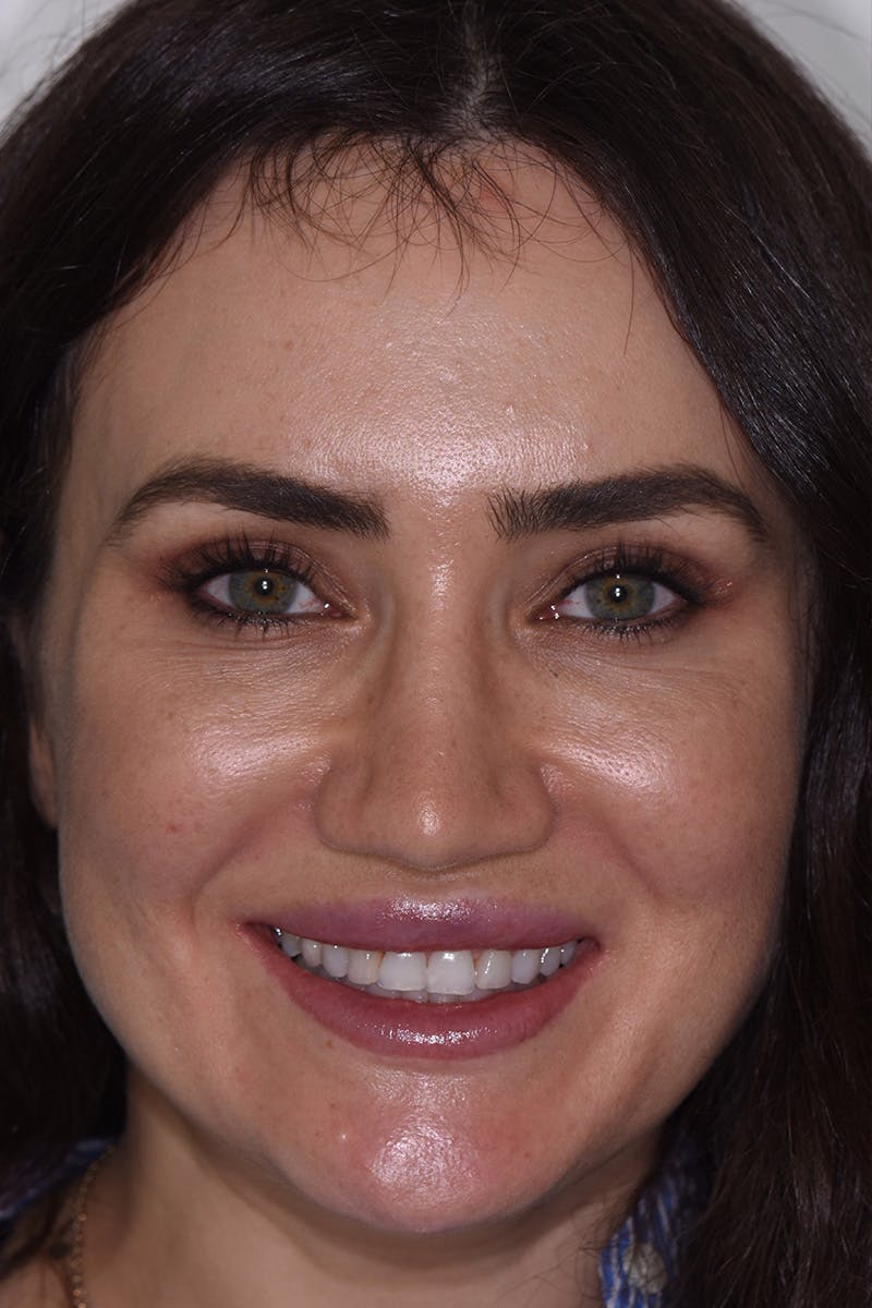 Patient Smile Before & After Gallery - Patient 183482 - Image 1