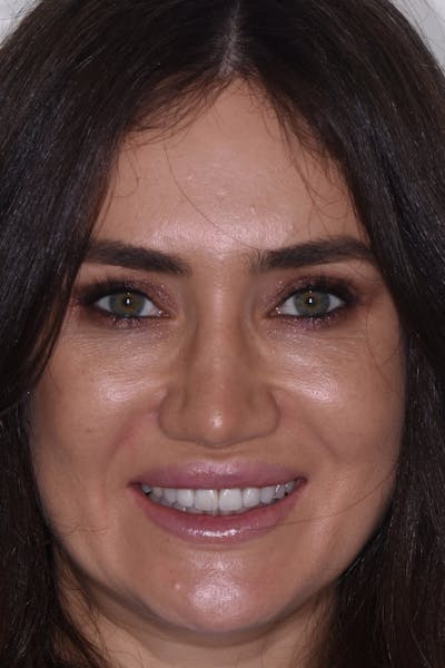 Patient Smile Before & After Gallery - Patient 183482 - Image 2