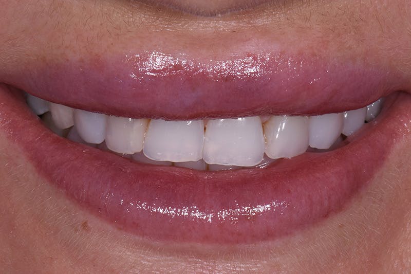 Patient Smile Before & After Gallery - Patient 183482 - Image 3