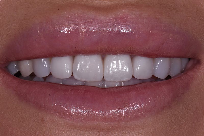 Patient Smile Before & After Gallery - Patient 183482 - Image 4