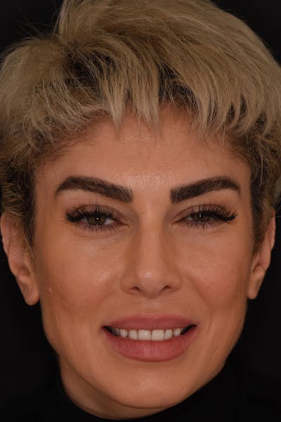 Patient Smile Before & After Gallery - Patient 852604 - Image 1