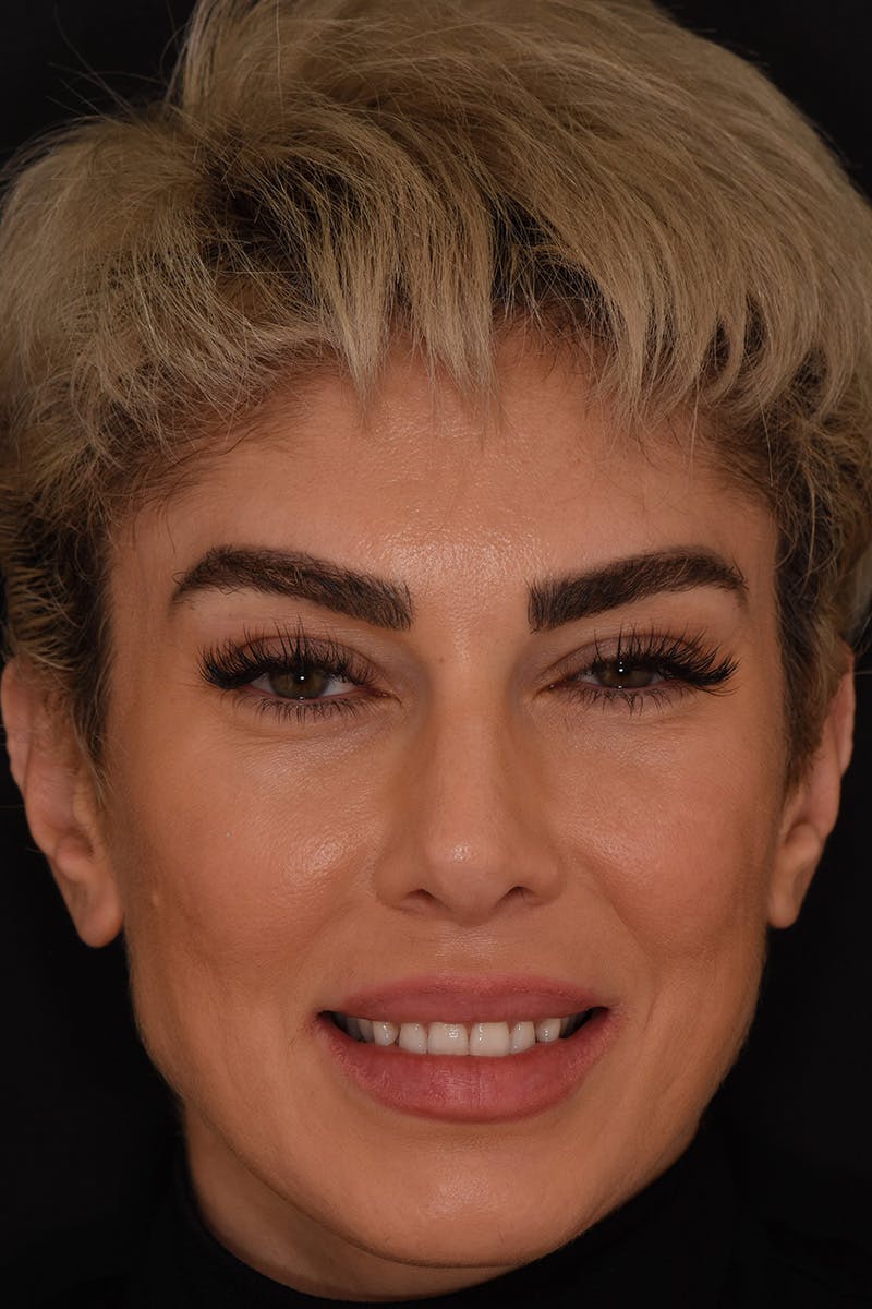 Patient Smile Before & After Gallery - Patient 852604 - Image 1