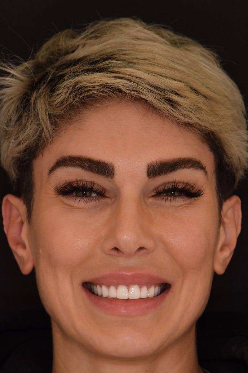 Patient Smile Before & After Gallery - Patient 852604 - Image 2