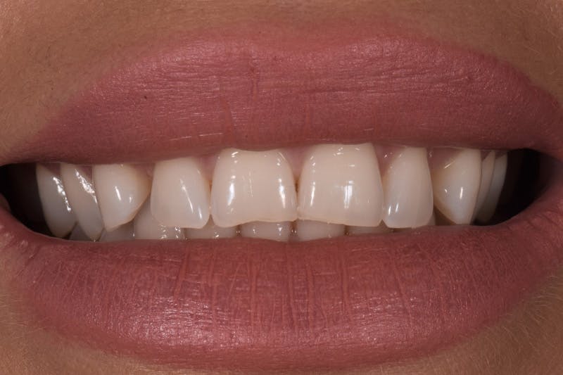 Patient Smile Before & After Gallery - Patient 852604 - Image 3