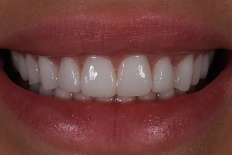 Patient Smile Before & After Gallery - Patient 852604 - Image 4