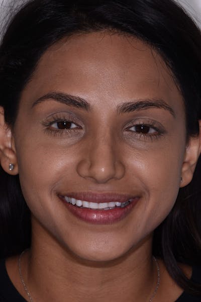 Patient Smile Before & After Gallery - Patient 161515 - Image 1
