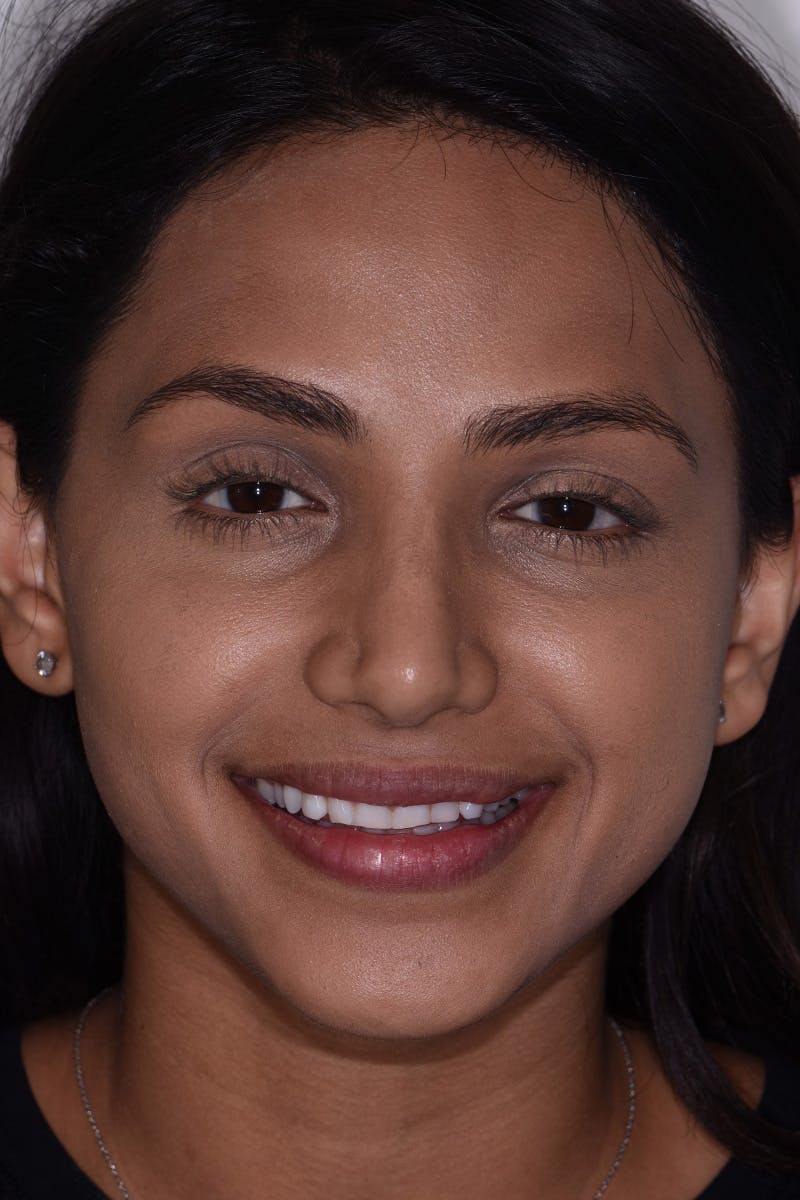 Patient Smile Before & After Gallery - Patient 161515 - Image 1