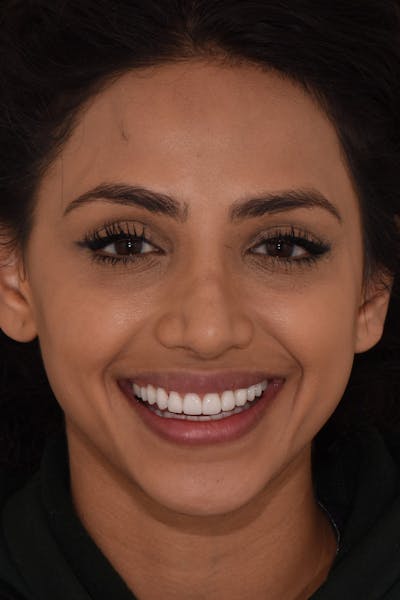 Patient Smile Before & After Gallery - Patient 161515 - Image 2