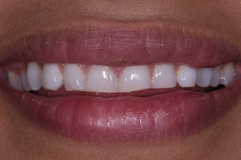 Patient Smile Before & After Gallery - Patient 161515 - Image 3