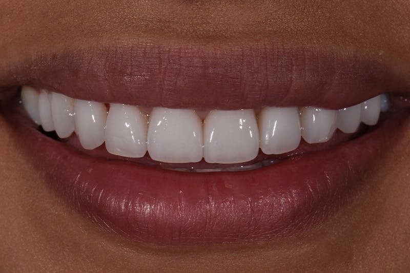 Patient Smile Before & After Gallery - Patient 161515 - Image 4