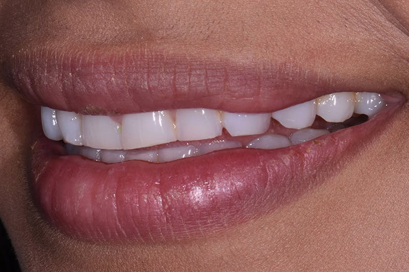 Patient Smile Before & After Gallery - Patient 161515 - Image 5