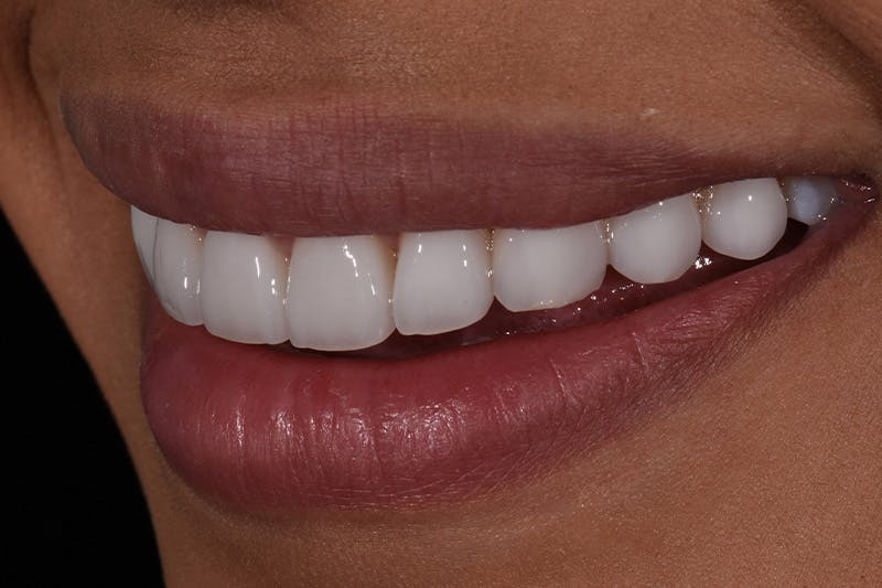 Patient Smile Before & After Gallery - Patient 161515 - Image 6