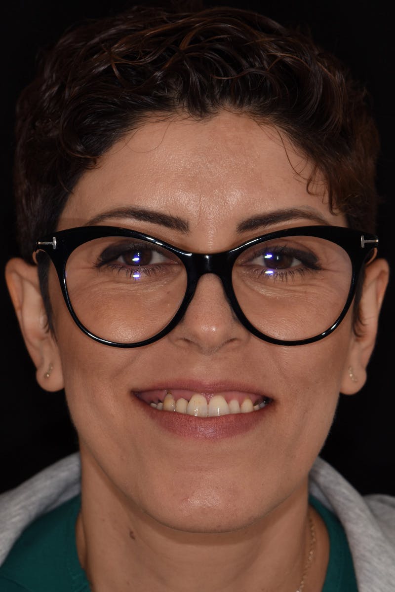 Patient Smile Before & After Gallery - Patient 326787 - Image 1