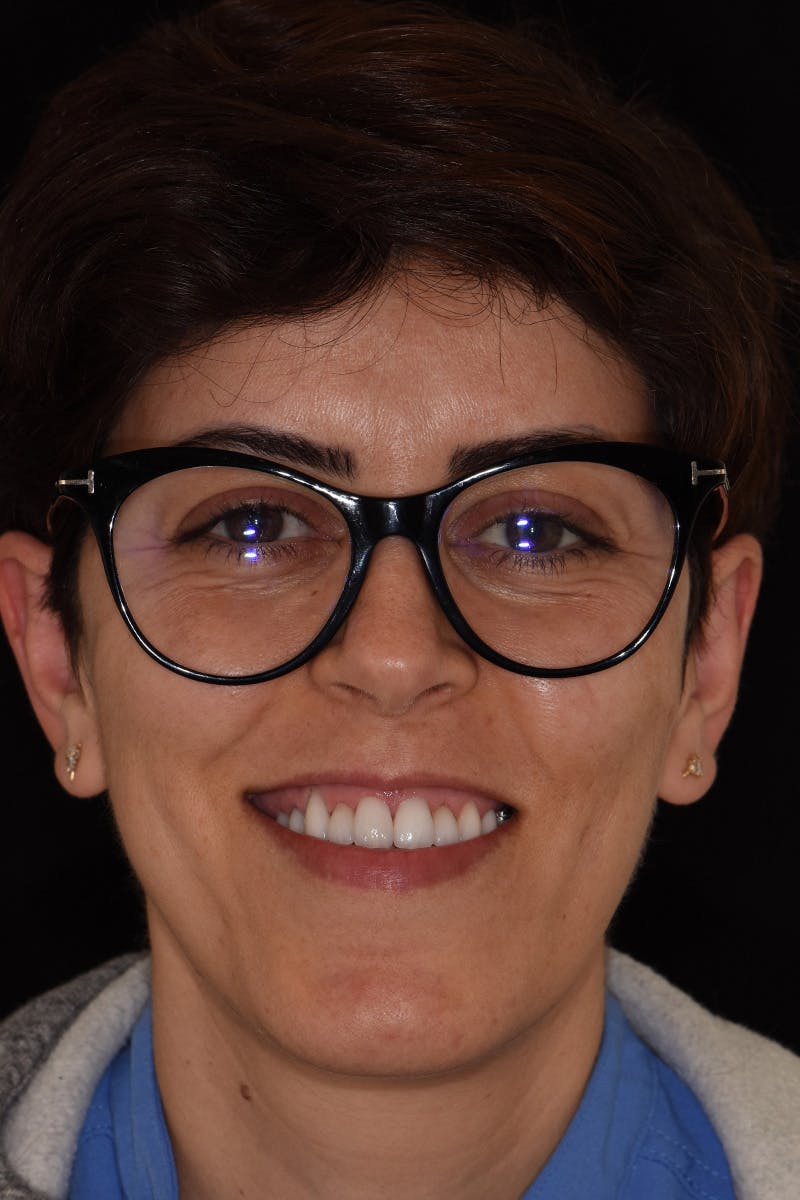 Patient Smile Before & After Gallery - Patient 326787 - Image 2