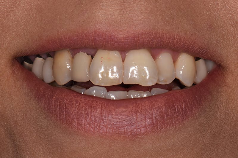 Patient Smile Before & After Gallery - Patient 326787 - Image 3