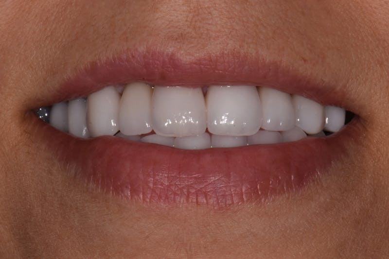 Patient Smile Before & After Gallery - Patient 326787 - Image 4