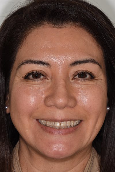 Patient Smile Before & After Gallery - Patient 404640 - Image 1