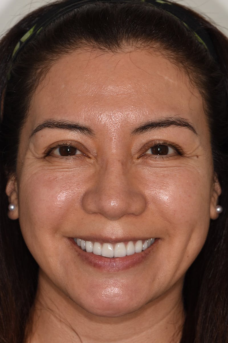 Patient Smile Before & After Gallery - Patient 404640 - Image 2