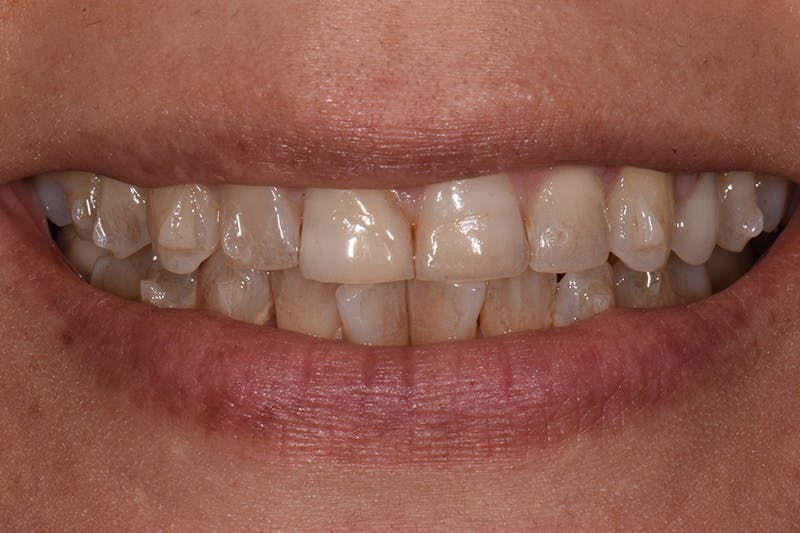 Patient Smile Before & After Gallery - Patient 404640 - Image 3