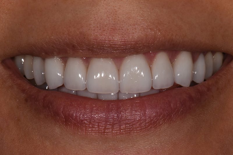 Patient Smile Before & After Gallery - Patient 404640 - Image 4