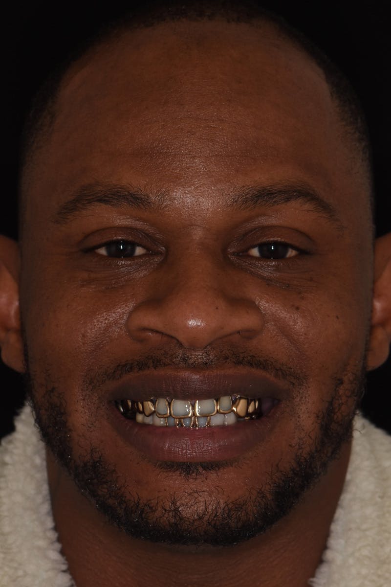 Patient Smile Before & After Gallery - Patient 224320 - Image 1