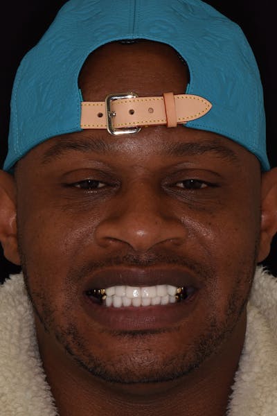 Patient Smile Before & After Gallery - Patient 224320 - Image 2