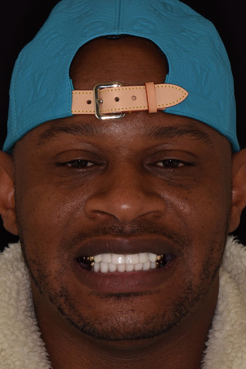 Patient Smile Before & After Gallery - Patient 224320 - Image 2