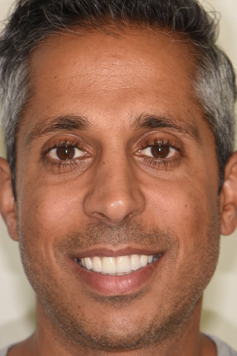 Patient Smile Before & After Gallery - Patient 368624 - Image 2