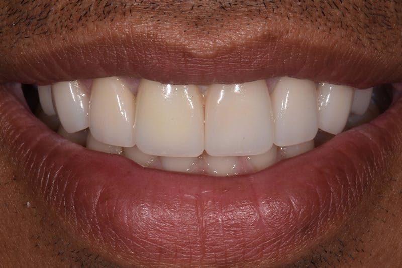 Patient Smile Before & After Gallery - Patient 368624 - Image 4