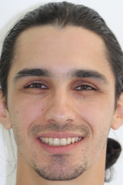 Patient Smile Before & After Gallery - Patient 378832 - Image 1