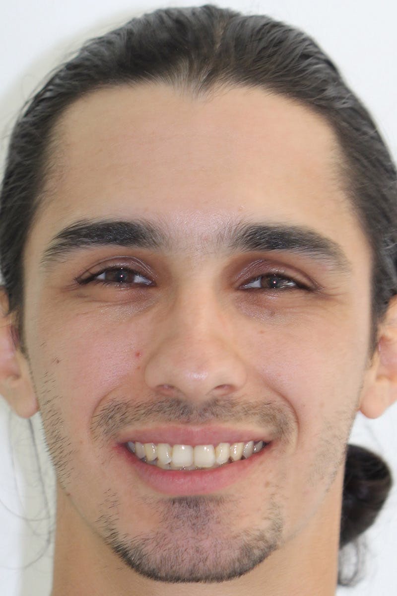 Patient Smile Before & After Gallery - Patient 378832 - Image 1
