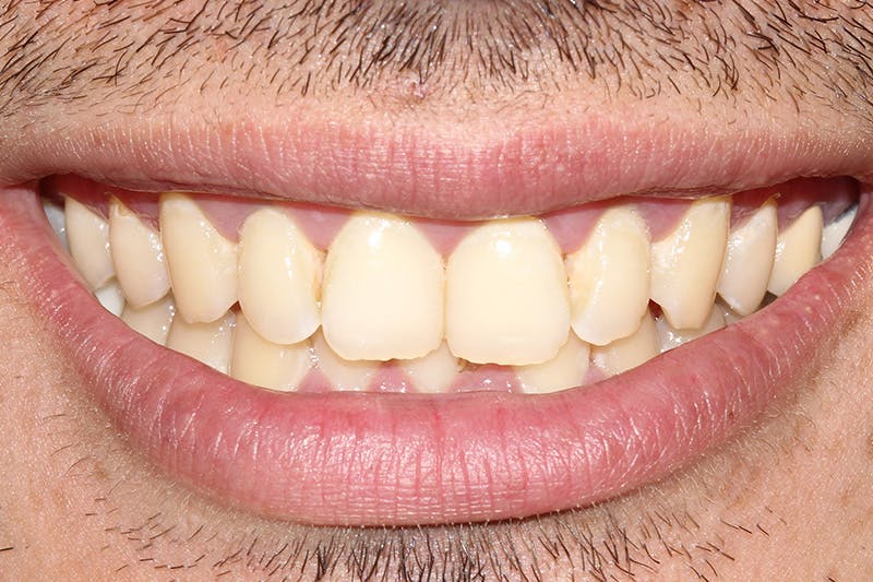 Patient Smile Before & After Gallery - Patient 378832 - Image 3