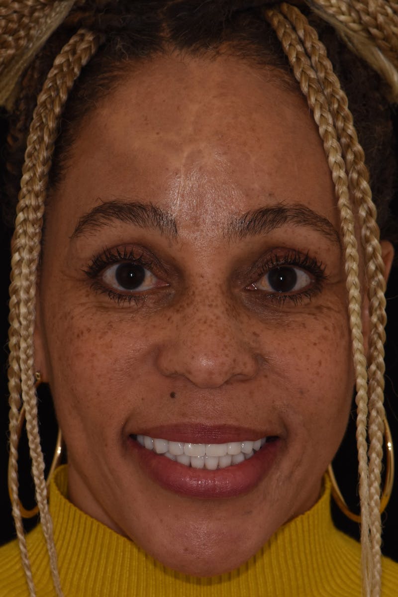 Patient Smile Before & After Gallery - Patient 601815 - Image 2