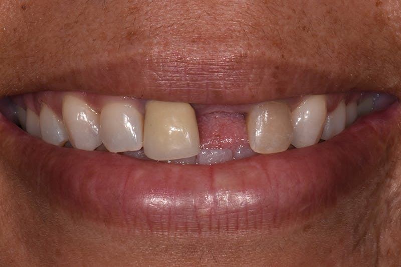 Patient Smile Before & After Gallery - Patient 601815 - Image 3