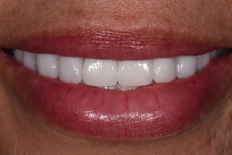 Patient Smile Before & After Gallery - Patient 601815 - Image 4