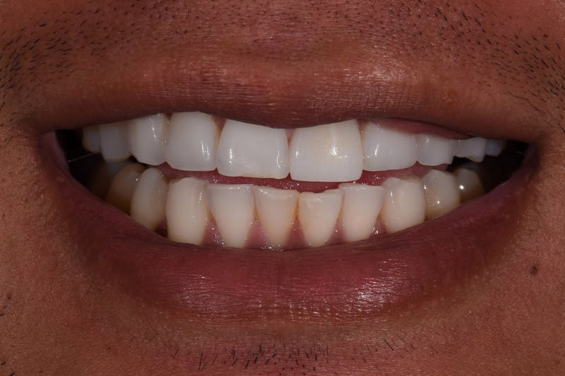 Patient Smile Before & After Gallery - Patient 192001 - Image 3