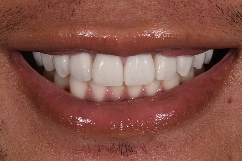 Patient Smile Before & After Gallery - Patient 192001 - Image 4