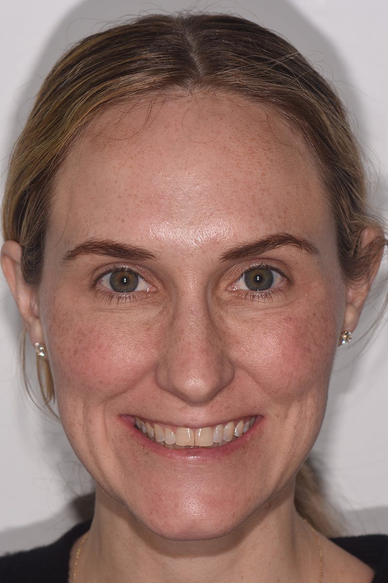 Patient Smile Before & After Gallery - Patient 170938 - Image 1