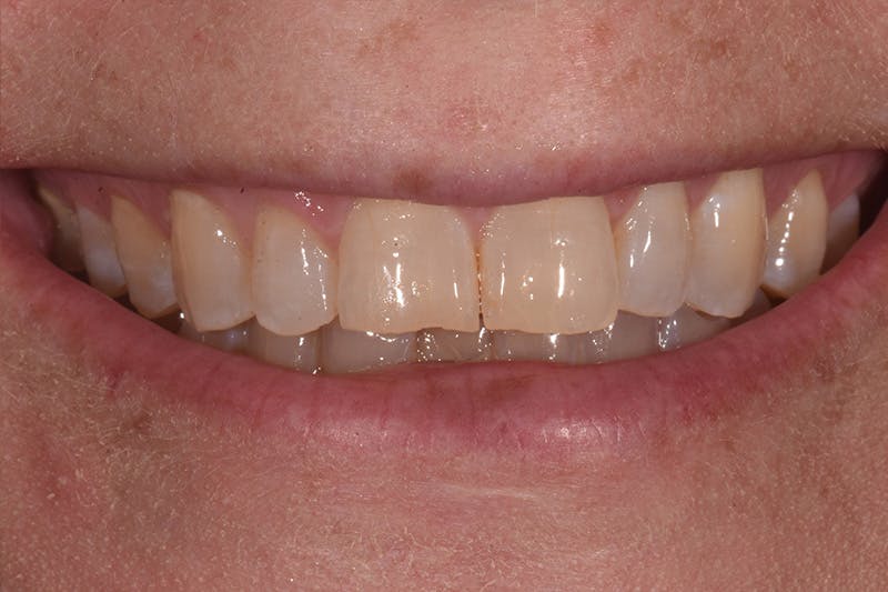 Patient Smile Before & After Gallery - Patient 170938 - Image 3