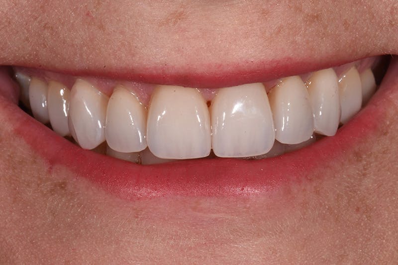 Patient Smile Before & After Gallery - Patient 170938 - Image 4