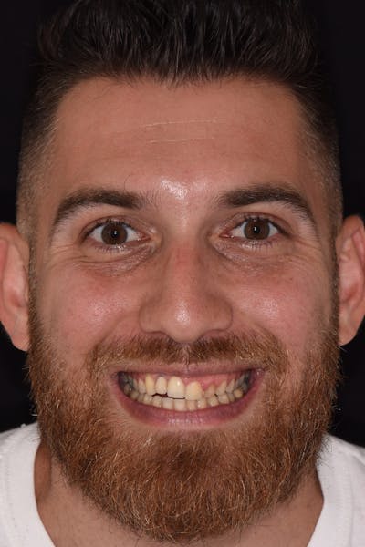 Patient Smile Before & After Gallery - Patient 138933 - Image 1