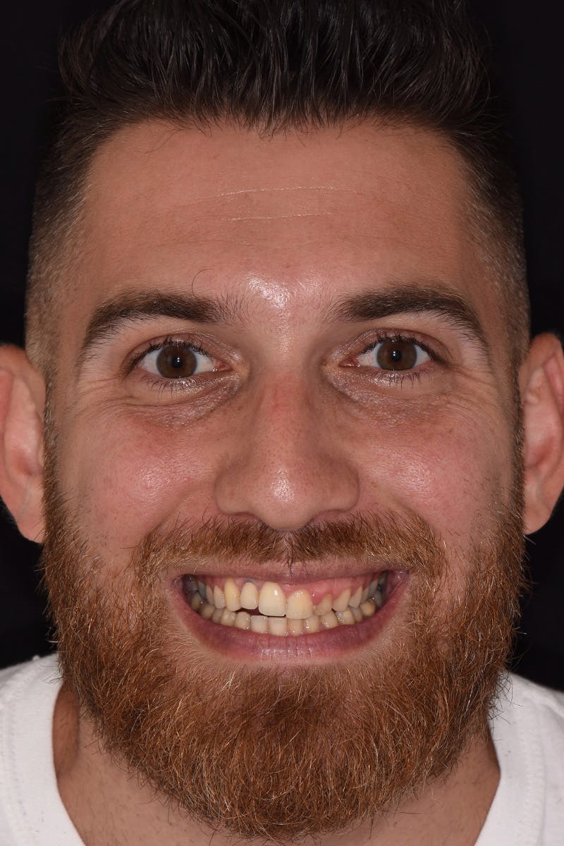 Patient Smile Before & After Gallery - Patient 138933 - Image 1